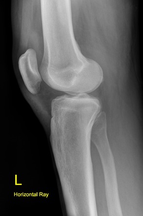 Fat pad separation sign (knee joint effusion) | Radiology Reference ...