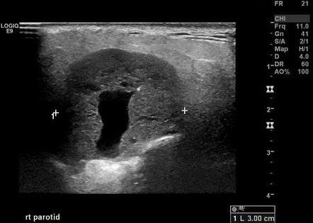 Acinic cell carcinoma (salivary glands) | Radiology Reference Article ...