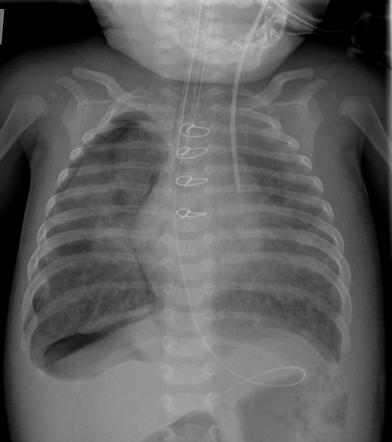 Left-sided SVC | Image | Radiopaedia.org