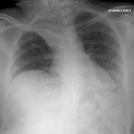 Right upper lobe collapse (rotated) | Radiology Case | Radiopaedia.org