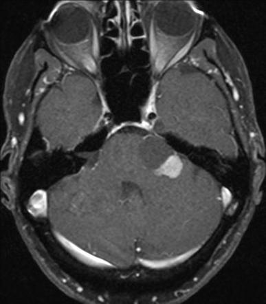 Vestibular schwannoma | Radiology Reference Article | Radiopaedia.org