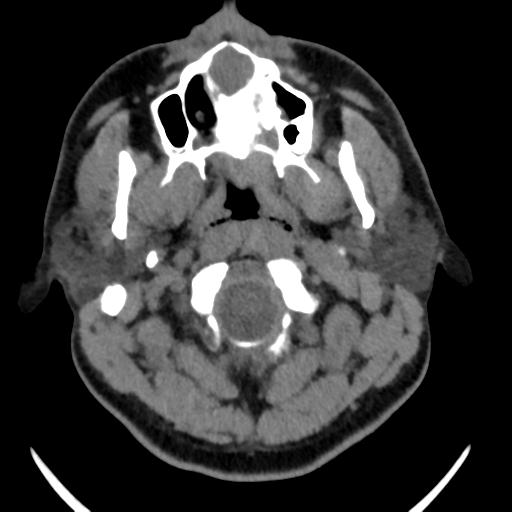 Nasopalatine Duct Cyst Image