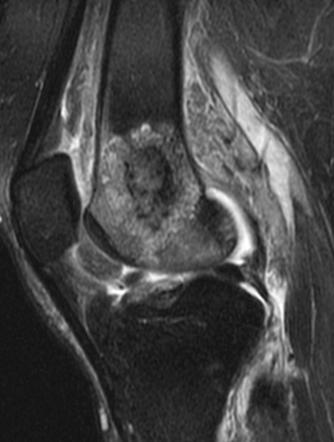 Osteomyelitis Radiology Reference Article Radiopaedia Org