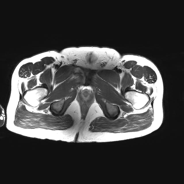 Adductor longus tear | Image | Radiopaedia.org