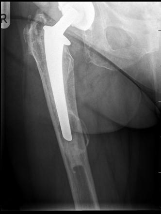 Aggressive granulomatosis post hip replacement | Radiology Reference ...