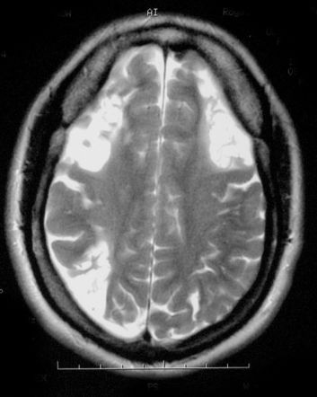 moyamoya disease radiology reference article radiopaedia org