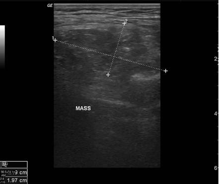 Intramuscular lipoma | Radiology Case | Radiopaedia.org