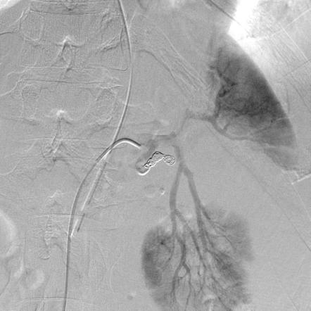 Shattered kidney with embolization | Radiology Case | Radiopaedia.org