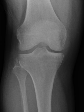 Knee radiograph (an approach) | Radiology Reference Article ...