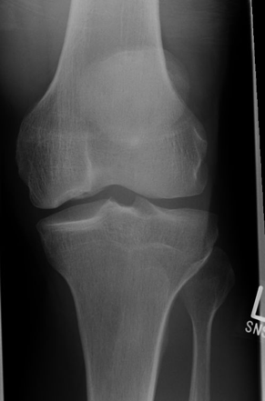 Osteochondral Defect 