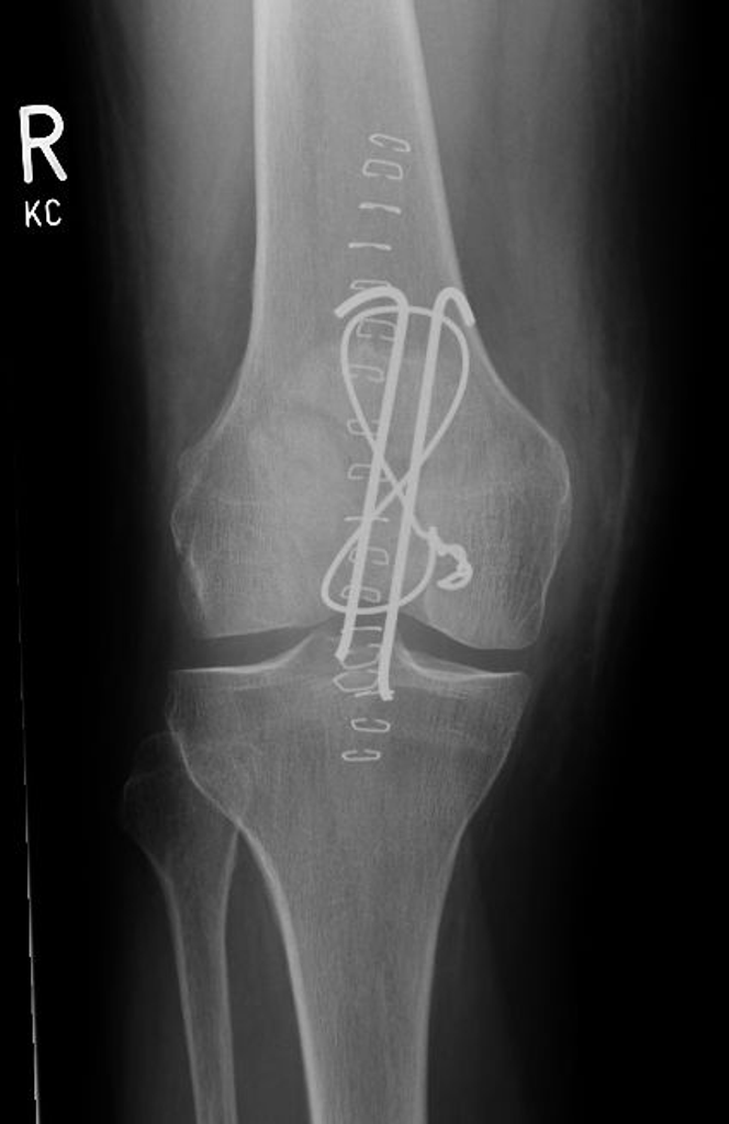 patella fracture surgery