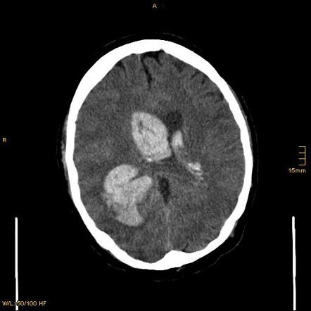 Cerebral arteriovenous malformation | Radiology Case | Radiopaedia.org