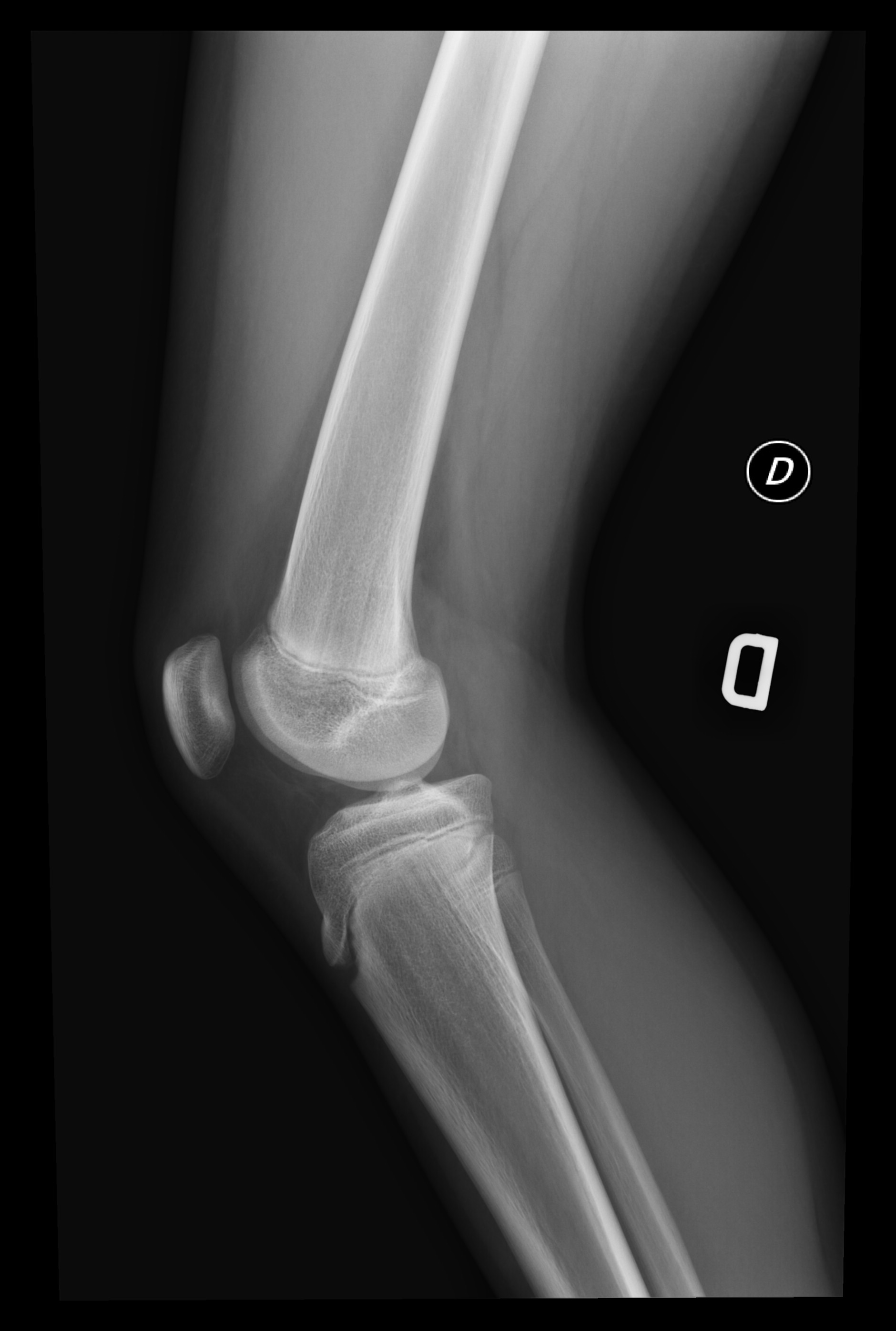 Osteopathia Striata Image Radiopaedia Org