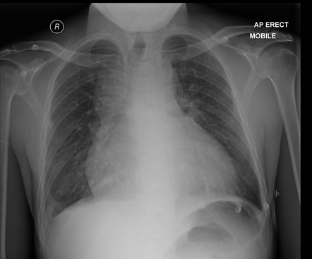 Aortic dissection on CTPA | Radiology Case | Radiopaedia.org