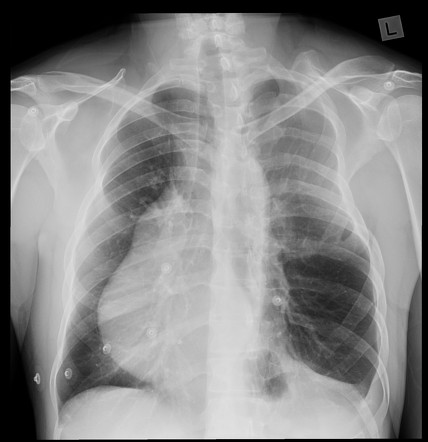 Poland Syndrome Radiology Case Radiopaedia Org