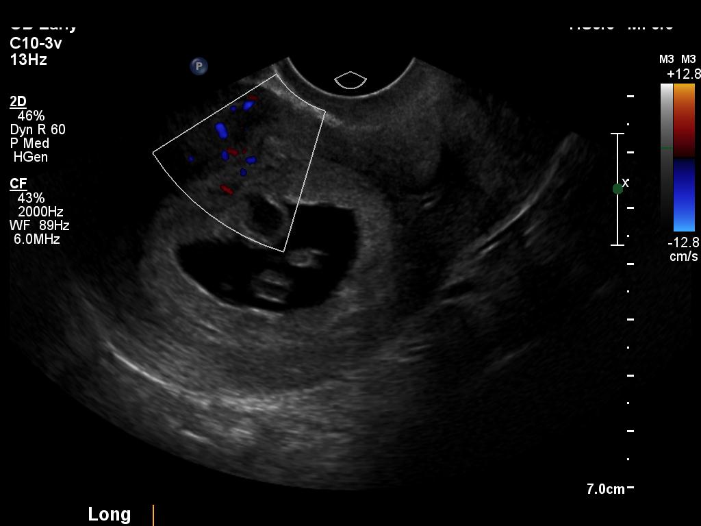 figure-5-from-the-chorionic-bump-a-first-trimester-pregnancy