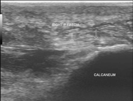 Plantar fibroma | Radiology Case | Radiopaedia.org