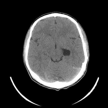 Choroidal fissure cyst | Radiology Reference Article | Radiopaedia.org