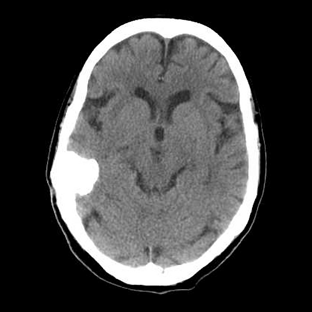 Calcified meningioma | Radiology Case | Radiopaedia.org