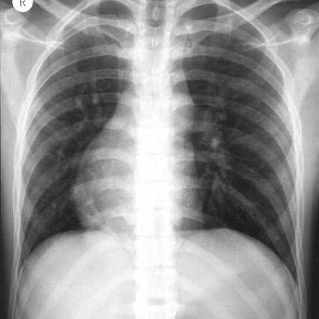 Dextrocardia Radiology Case Radiopaedia Org