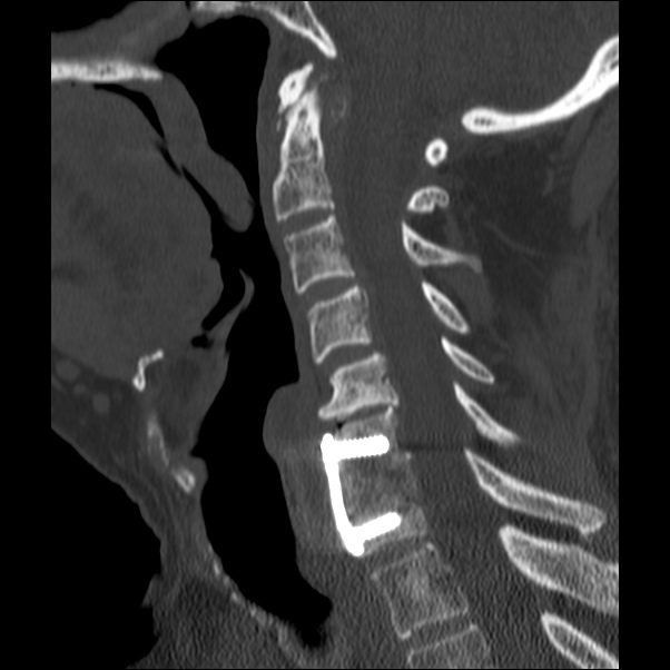 Anterior cervical postdiscectomy arthrodesis | Image | Radiopaedia.org