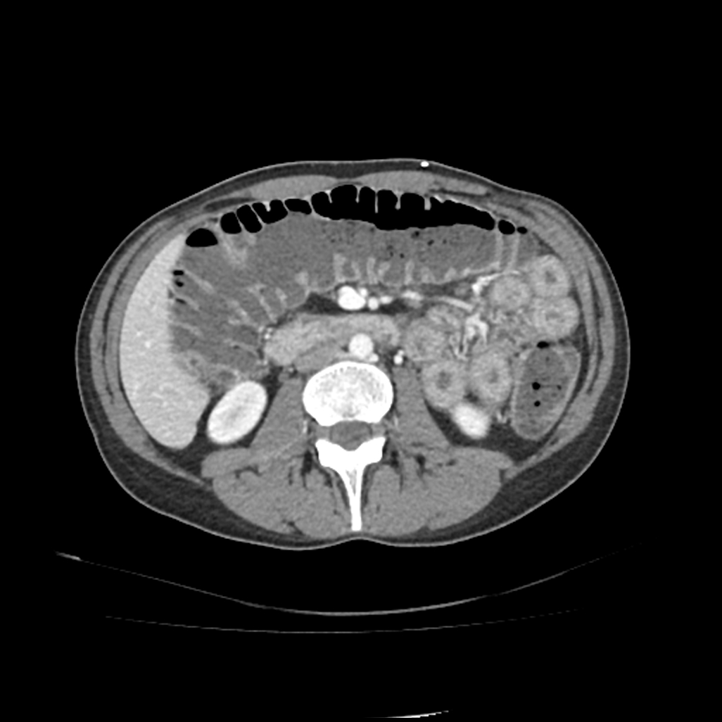 Graft versus host disease in lung transplant patient for cystic ...