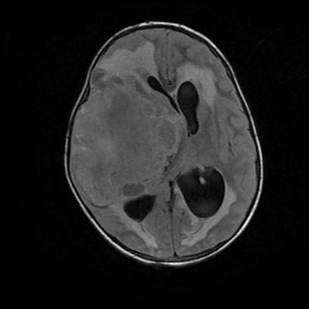 Primitive neuroectodermal tumor of the CNS | Image | Radiopaedia.org