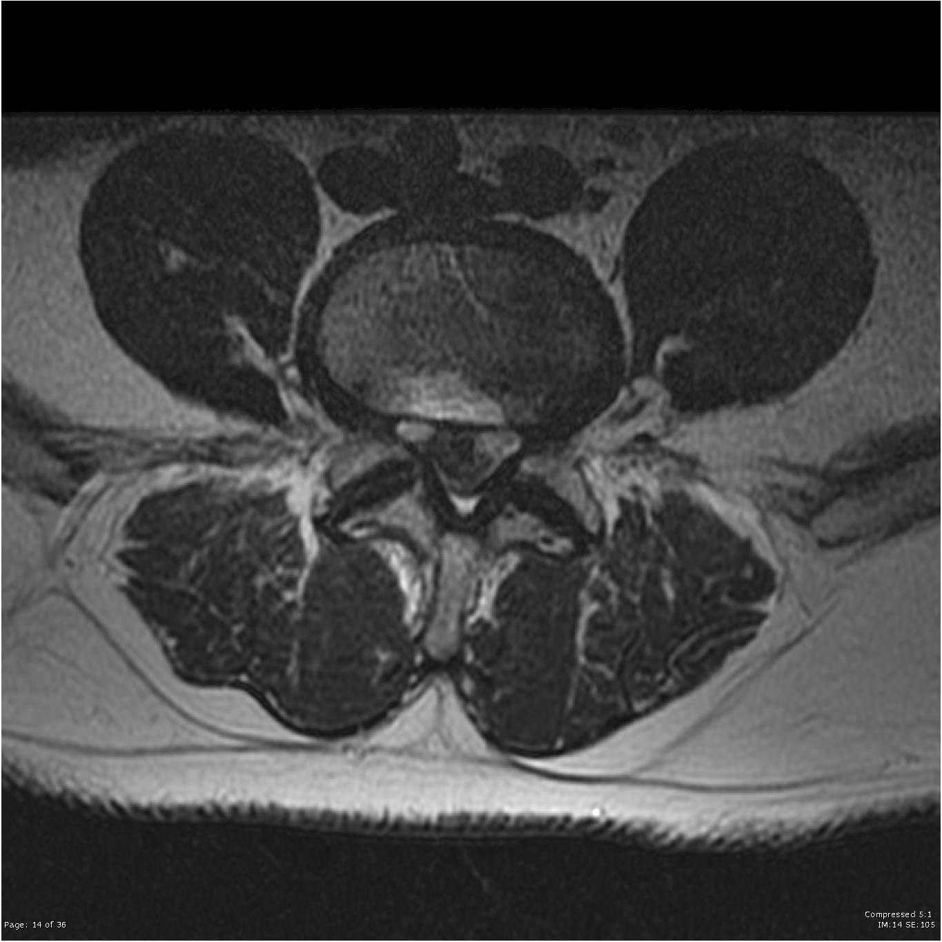 Lumbar Spine MRI Labeled