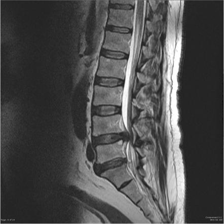 Cauda equina syndrome | Radiology Reference Article | Radiopaedia.org