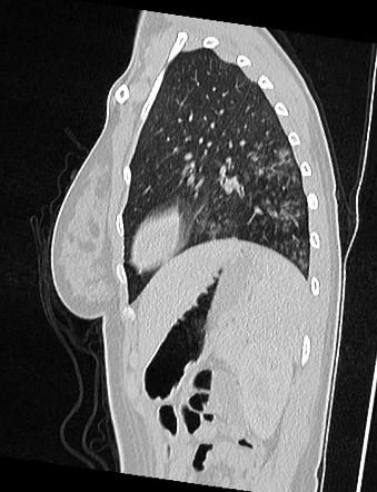 Tree-in-bud sign - normal CT virtual bronchoscopy | Image | Radiopaedia.org