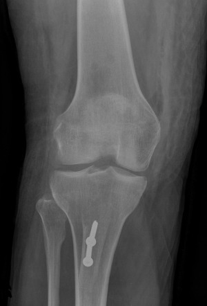 Fulkerson procedure | Radiology Case | Radiopaedia.org