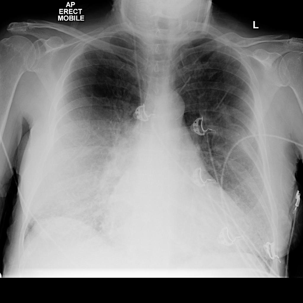 Lung consolidation Patterns of