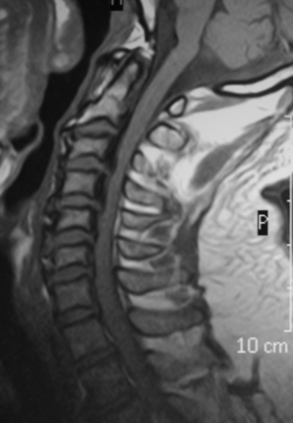 Ossification Of The Posterior Longitudinal Ligament Image