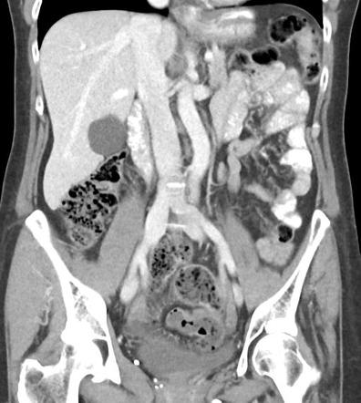 Small bowel feces sign | Image | Radiopaedia.org