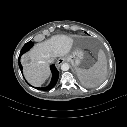 Cirrhotic Liver Nodules Differential Radiology Reference Article Radiopaedia Org