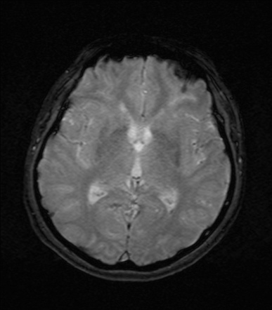 Thrombosed brainstem developmental venous anomaly | Image | Radiopaedia.org