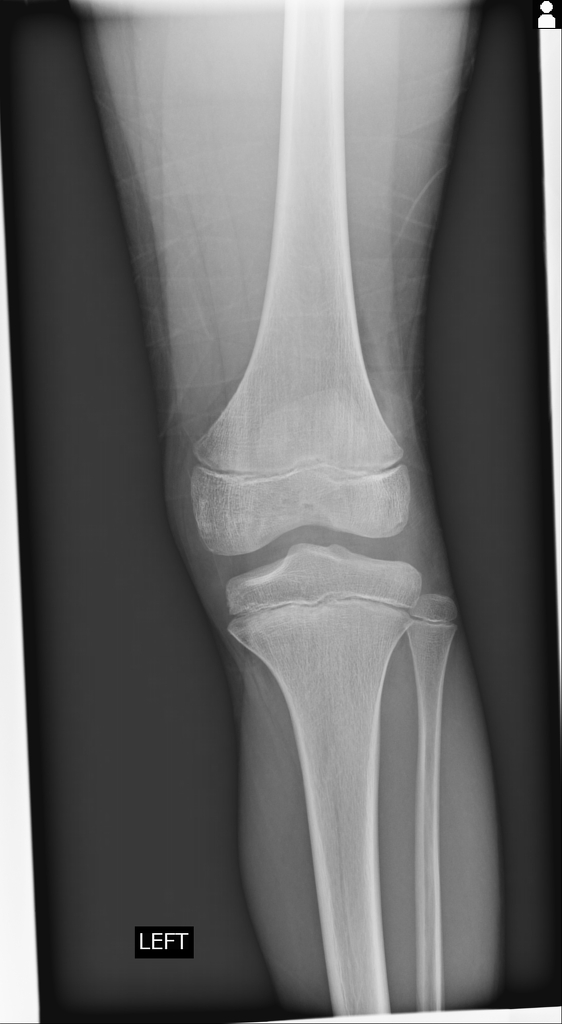 Cortical Desmoid Radiology Case Radiopaedia Org