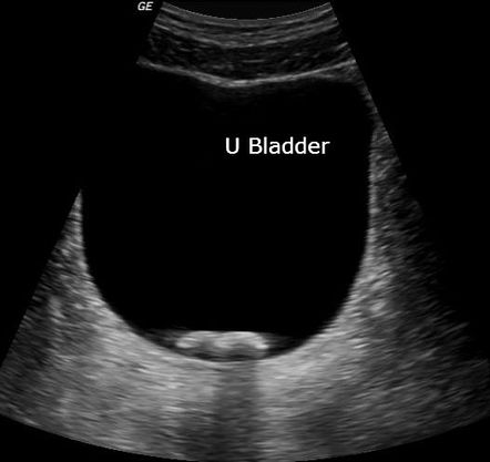 Urinary bladder calculus | Radiology Case | Radiopaedia.org