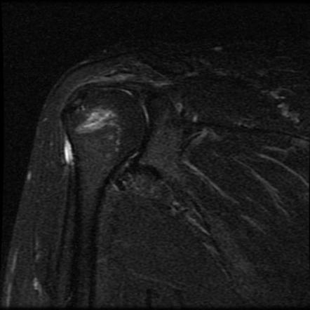 Reverse Hill-Sachs lesion | Radiology Case | Radiopaedia.org