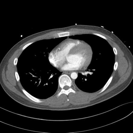 Traumatic aortic injury and bowel injury | Radiology Case | Radiopaedia.org