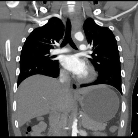 Traumatic aortic injury and bowel injury | Image | Radiopaedia.org