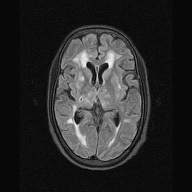 Binswanger Disease Subcortical Arterioslcerotic Encephalopathy Radiology Case Radiopaedia Org