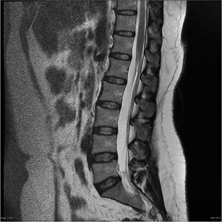 Fatty filum terminale | Image | Radiopaedia.org