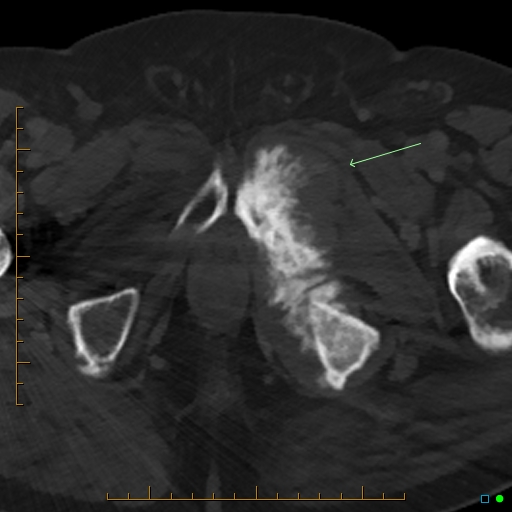 Exuberant Sclerotic Metastasis Prostate Cancer Image 0949