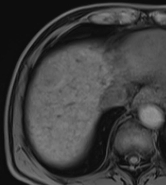 LI-RADS 5 lesion | Image | Radiopaedia.org