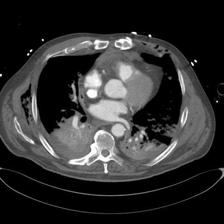 Cardiac trauma | Radiology Case | Radiopaedia.org