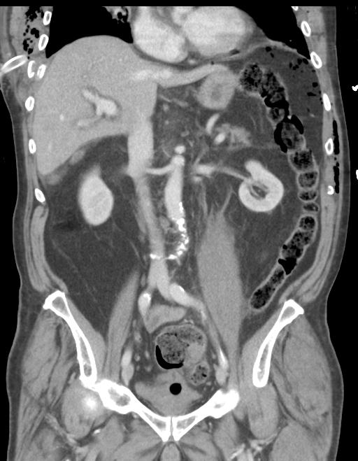 Cardiac trauma | Image | Radiopaedia.org