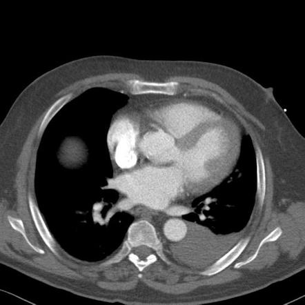 Penetrating chest and abdominal injuries | Radiology Case | Radiopaedia.org