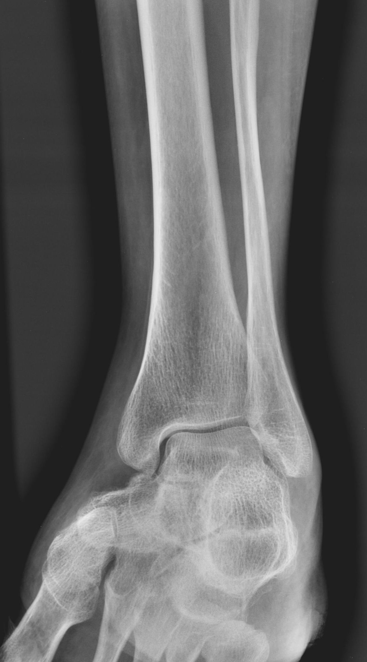 Degenerative disease of talonavicular joint | Image | Radiopaedia.org