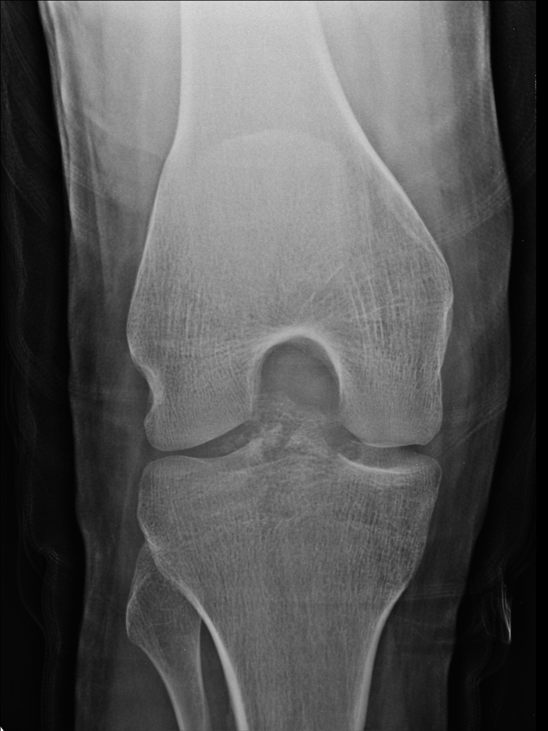 Intercondylar Fossa X Ray